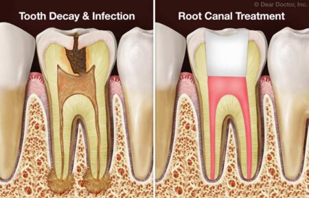 Two side-by-side images of a tooth before and after root canal therapy. The bio-ceramic sealer helps secure the filling in the second image.