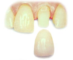 San Antonio Final Restoration for a Root Canal Tooth | San Antonio ...