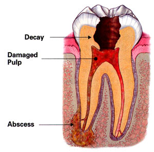 Illustration of a tooth in need of a root canal treatment