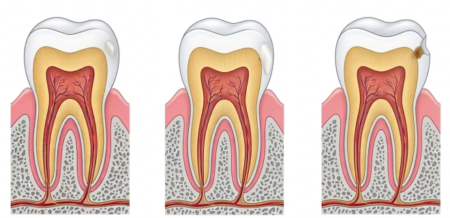 Progression of white spot lesions