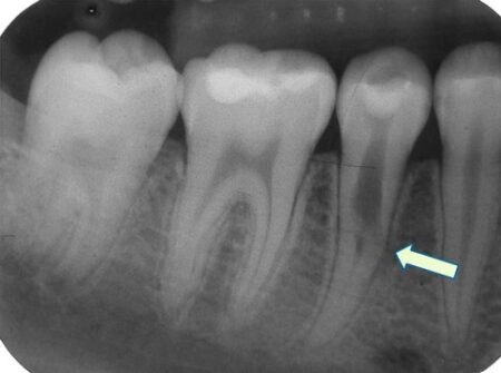A cavity on the inside of a tooth from root resorption